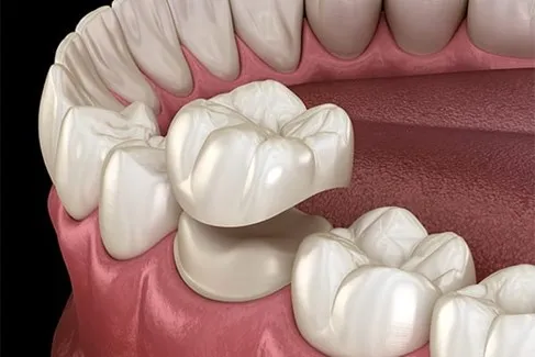 Ceramic Dental Crown